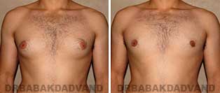 Before & After Photos. Gynecomastia. 22 year old. Man - front view