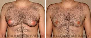 Before & After Photos. Gynecomastia. 28 year old. Male - front view