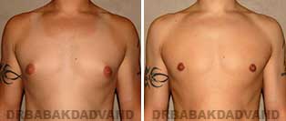 Before & After Photos. Gynecomastia. 27 year old. Man - front view