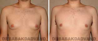 Before and After Photos. Gynecomastia. 24 year old. Man - front view