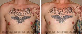 Before and After Photos. Gynecomastia. 28 year old. Male - front view