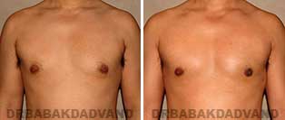 Before and After Photos. Gynecomastia. 36 year old. Man - front view