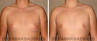 Before and After Photos. Gynecomastia. 15 year old. Man - front view