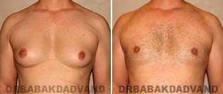 Before and After Photos. Gynecomastia. 35 year old. Man - front view
