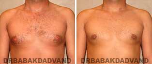 Before and After Photos. Gynecomastia. 32 year old. Man - front view