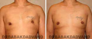Before and After Photos. Gynecomastia. 34 year old. Male - front view