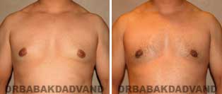 Before and After Photos. Gynecomastia. 27 year old. Male - front view