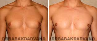 Before and After Photos. Gynecomastia. 20 year old. Man - front view