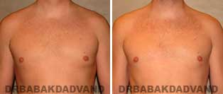 Before and After Photos. Gynecomastia. 36 year old. Male - front view