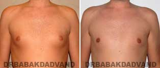 Before and After Photos. Gynecomastia. 40 year old. Male - front view