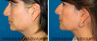 Necklift: Before and After Photos - 39 year old women, left side view