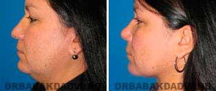 Necklift: Before and After Photos - 42 year old women, left side view