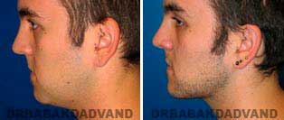 Necklift: Before and After Photos - 26 year old male, left side view