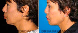 Necklift: Before and After Photos - 55 year old women, left side view