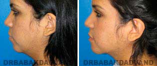 Necklift: Before and After Photos - 20 year old women, left side view