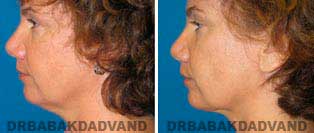 Necklift: Before and After Photos - 42 year old women, left side view