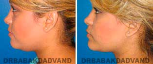 Necklift: Before and After Photos - 23 year old women, left side view