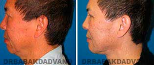 Necklift: Before and After Photos - 57 year old male, left side view