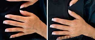 Radiesse: Before and After Photos - Hands female, front view