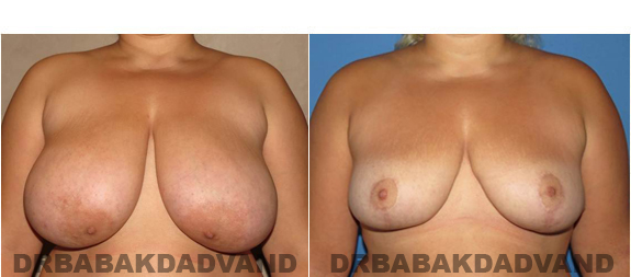 Before and After Photos. Breast-Reduction: - 62 year old female, front view