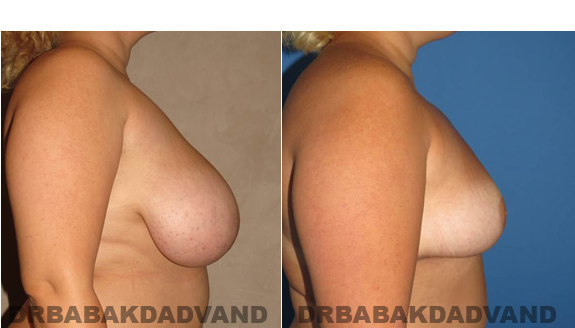 Before and After Photos. Breast-Reduction: - 62 year old female, right side view