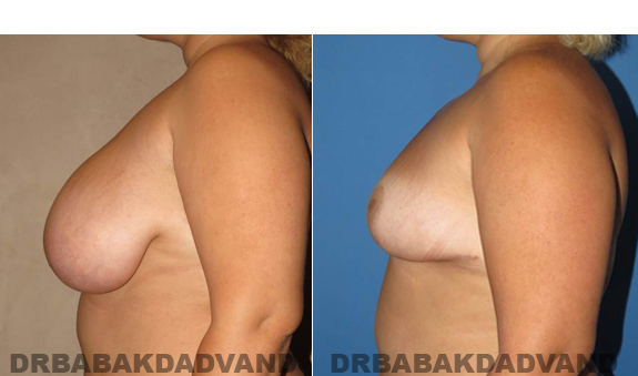 Before and After Photos. Breast-Reduction: - 62 year old female, left side view