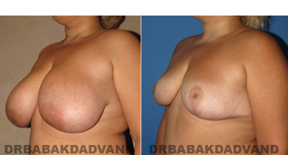 Before and After Photos. Breast-Reduction: - 62 year old female, left side, oblique view