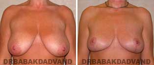 Breast Before & After Photos. Breast reduction