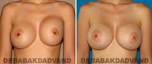 Revision Breast. Before and After Photos. 46 year old woman - front view