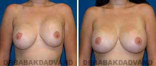 Breast Before & After Photos. Revision Breast Surgery