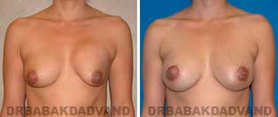 Revision Breast. Before and After Photos. 36 year old woman - front view
