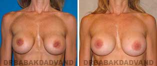 Revision Breast. Before and After Photos. 46 year old woman - front view