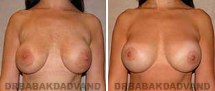 Revision Breast. Before and After Photos. 32 year old woman - front view