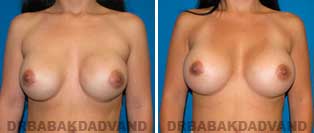 Revision Breast. Before and After Photos. 37 year old woman - front view