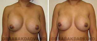 Revision Breast. Before and After Photos. 28 year old woman - front view