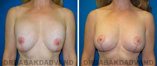 Revision Breast. Before and After Photos. 53 year old woman - front view