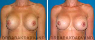Revision Breast. Before and After Photos. 32 year old woman - front view