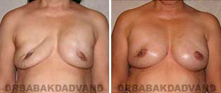 Revision Breast. Before & After Photos. 62 year old woman - front view