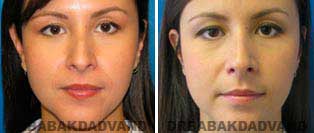 Rhinoplasty: Before and After Photos - 34 year old women, front view