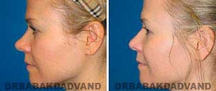 Rhinoplasty: Before and After Photos - 38 year old women, left side view