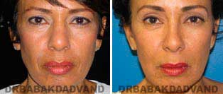Rhinoplasty: Before and After Photos - 57 year old women, front view