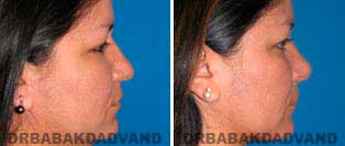 Rhinoplasty: Before and After Photos - 40 year old women, right side view