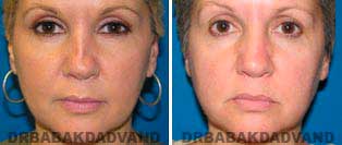 Rhinoplasty: Before and After Photos - 46 year old women, front view