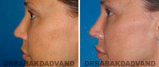 Rhinoplasty: Before and After Photos - 42 year old women, left side view
