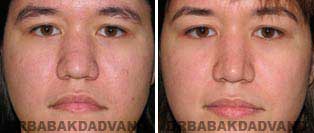 Rhinoplasty: Before and After Photos - 24 year old women, front view