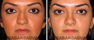 Rhinoplasty: Before and After Photos - 22 year old women, front view