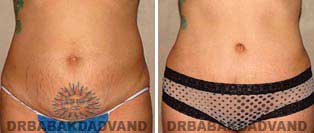 Body Before & After Photos: Tummy Tuck