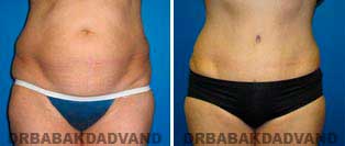 Tummy Tuck: Before and After Photos. 57 year old female - front view