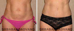 Tummy Tuck: Before and After Photos. 42 year old female - front view