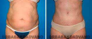 Tummy Tuck: Before and After Photos. 51 year old female - front view